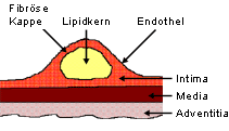 Schematischer Aufbau einer fortgeschrittenen arteriosklerotischen Plaques